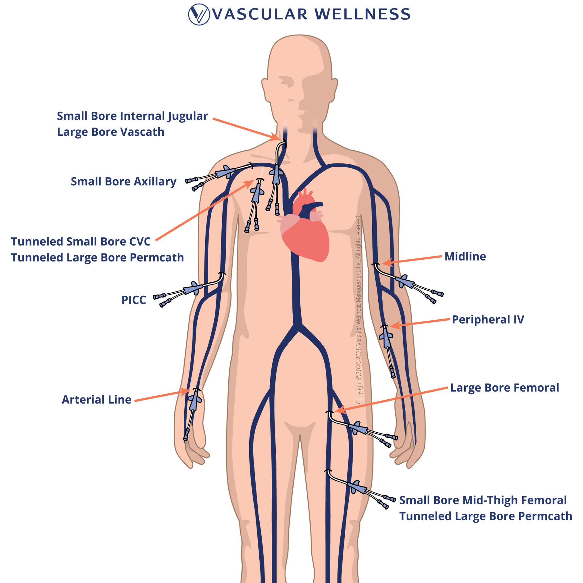 "Vein-Man" Illustration of Vascular Access Lines