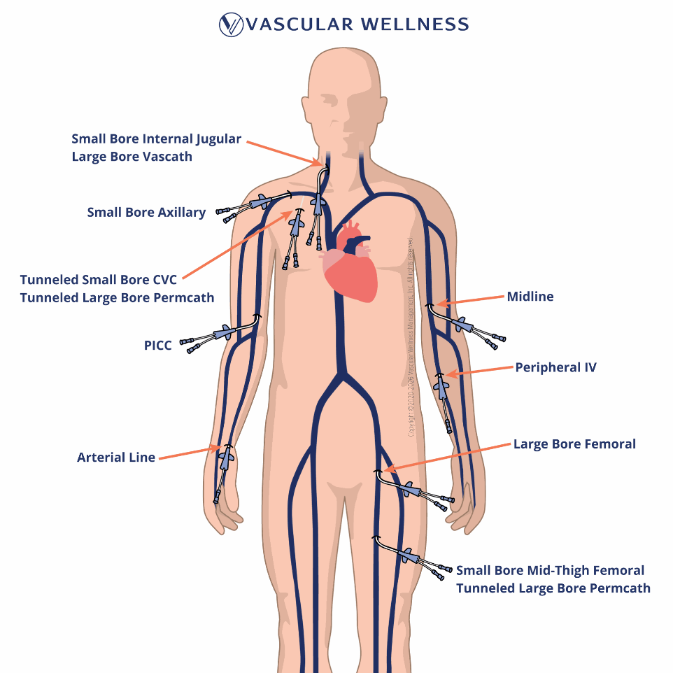 Vascular Wellness Illustration of Vascular Access Lines Placed at the Bedside